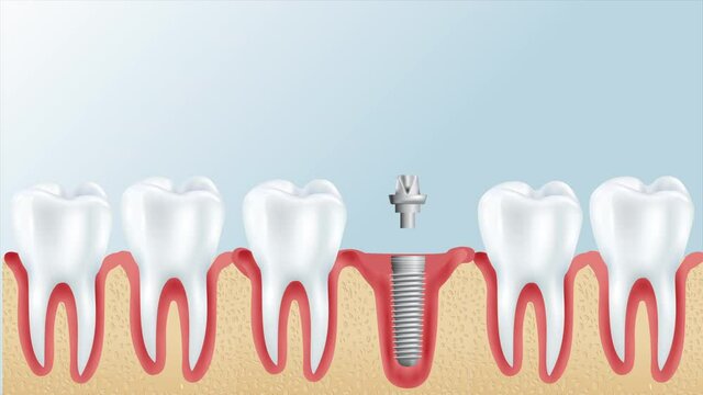 Tooth implant instalation process, Medically accurate 3D illustration white style. 4k motion video.