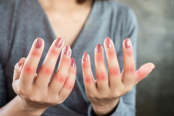 closeup woman suffering from hand and finger pain can be use for knuckle , joint pain and gout...