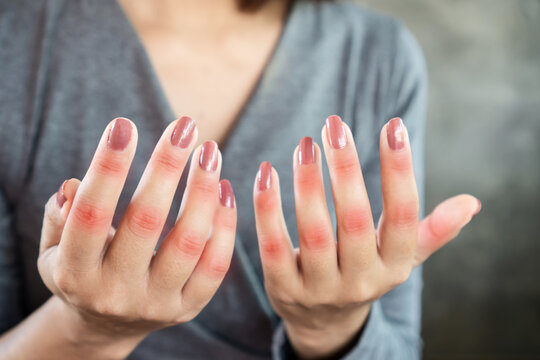 Closeup Woman Suffering From Hand And Finger Pain Can Be Use For Knuckle , Joint Pain And Gout Concept