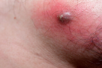 The inflammation of the swelling from abscess on the chest of asia man.