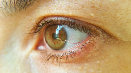 Blood vessel on the eyeball. Intraocular pressure. Bloodshot eyes. Close-up macro photography....