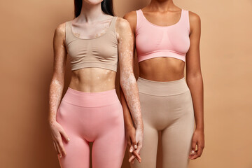 Skin condition feminine concept. Unrecognizable two lesbian women hold hands dressed in underwear. Vitiligo affected and dark skinned ladies indoor. Depigmentation