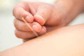 Detail of applying acupuncture needles on a patient's back - obrazy, fototapety, plakaty