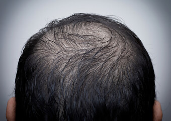 Close up man's head with hair loss, thinning hair or alopecia isolated on white background. Hair problem.