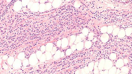 Breast cancer histology (biopsy): Microscopic image (photomicrograph) of an infiltrating (invasive) lobular carcinoma, detected by screening mammogram. H & E stain.