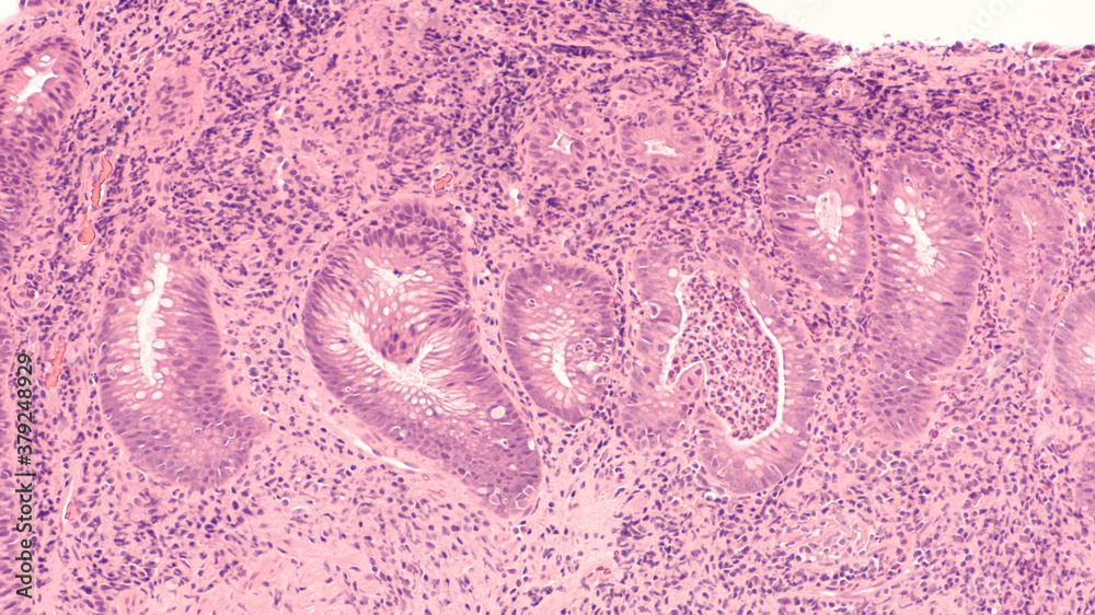 Wall mural Photomicrograph of a colon biopsy obtained during colonoscopy showing ulcerative colitis, a type of inflammatory bowel disease (IBD).  Branched crypts with cryptitis and crypt abscesses are seen. 