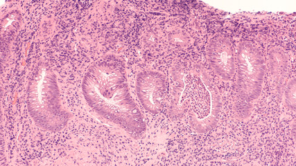 Photomicrograph of a colon biopsy obtained during colonoscopy showing ulcerative colitis, a type of...