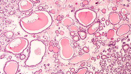 Photomicrograph showing histology of a benign thyroid nodule in a patient with multinodular goiter.  Follicles of varying size are seen, many filled with colloid material. - obrazy, fototapety, plakaty