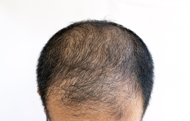 Top view of baldness men's head with thin hair on his top and forehead. Conceptual of hair problem on men's head.