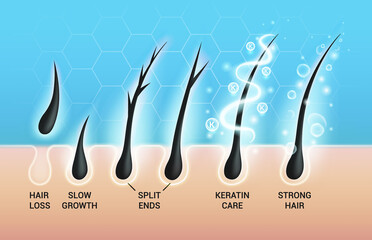 Different hair problems and deep salon treatment vector illustrations set, macro view of balding scalp skin and follicles.