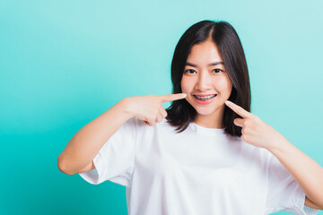 Fototapeta premium Portrait of Asian teen beautiful young woman smile have dental braces on teeth laughing point finger her mouth, studio shot isolated on a blue background, Medicine and dentistry concept