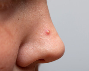 inflamed acne on the nose