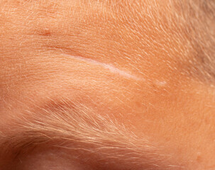 white hairs on tanned skin with a white scar