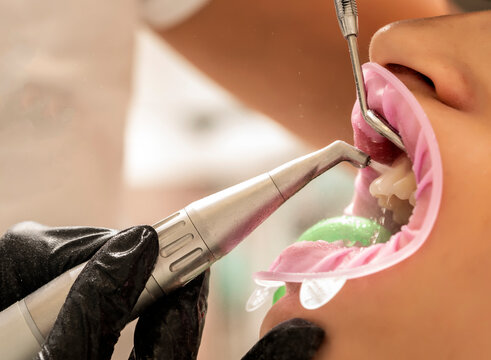 teeth sandblasting, tartar cleaning and whitening