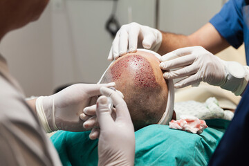 Obraz na płótnie Canvas Hair transplantation is a surgical technique that moves hair follicles from a part of the body called