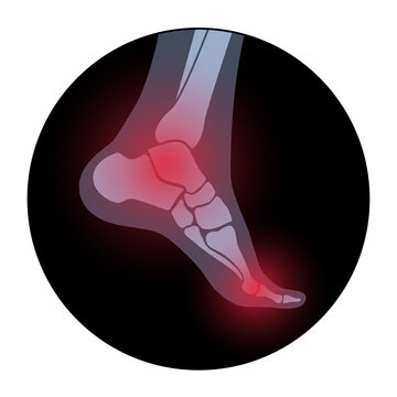 Arthritis foot concept