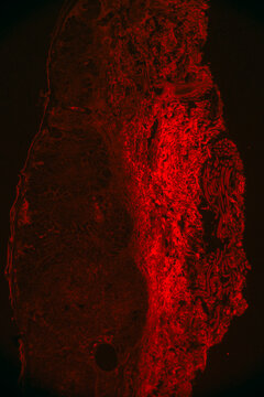 human cells, basal cell cancer of eyes