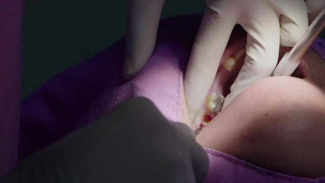 Dentist clinic office. Doctor and assistant performing extraction procedure with forceps removing patient tooth. Healthcare dentistry medicine concept.