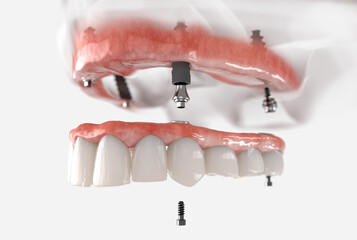 Maxillary prosthesis