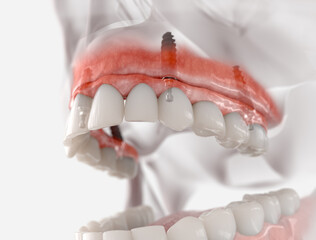 Maxillary prosthesis