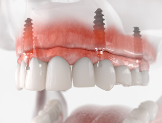 Maxillary prosthesis