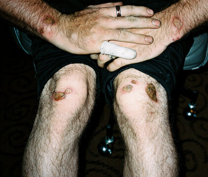 male with scabs sores after motorcycle crash accident