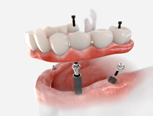 Mandibular fixed restoration with 4 implants.  3d illustration of implant on white background.