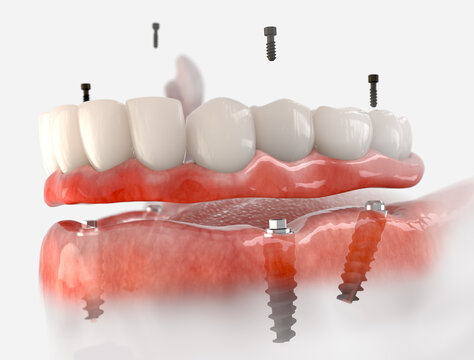 Mandibular fixed restoration with 4 implants.  3d illustration of implant on white background.