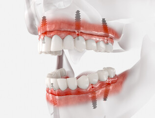 Mandibular and Maxillary prosthesis