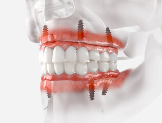Mandibular and Maxillary prosthesis
