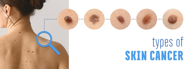Young woman with different types of moles. Concept of skin cancer