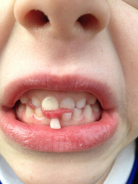 Wobbly tooth