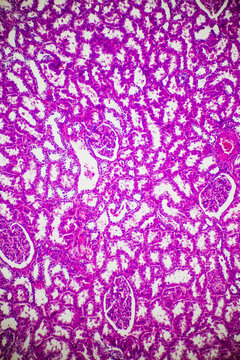 Compression atrophy of human kidney