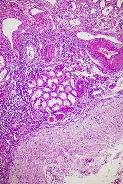 Compression atrophy of human kidney