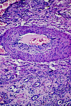 human kidney tissue infarction