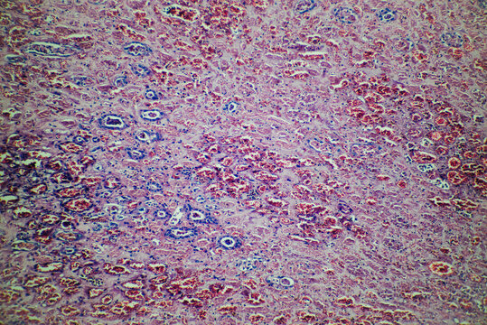 human kidney tissue infarction