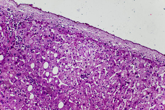 human liver tissue showing fatty degeneration