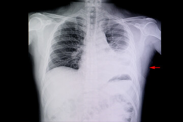 Chest xray of a patient with pneumonia