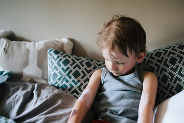 a little boy with calamine lotion on the poison ivy on his arms