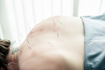 Acupuncture Needles
