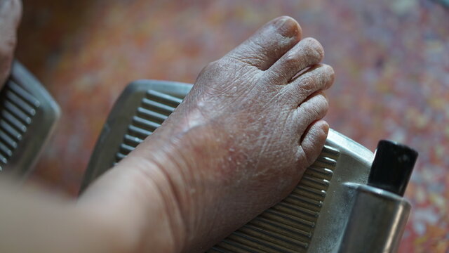 swollen foot