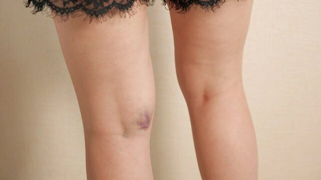 Lady in black nightie shows large bruise in kneepit and turns around to demonstrate on leg against white wall at home closeup