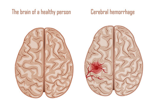 Human brain. Diseases of the brain, nervous system. Vector illustration
