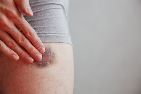 Man applies the healing gel to the bruise. Bruise on leg