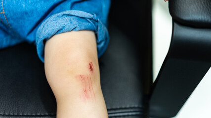 Scraped knees in the blood of a little child who fell. Childhood injuries.