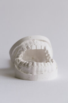 Plaster models of upper and lower teeth