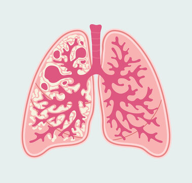 Tuberculosis in lung of human. Respiratory diseases - T.B. - Anatomical diagram in hand drawn style. Patient-friendly scheme of TB damages in human lungs. Tuberculosis - vector infographics
