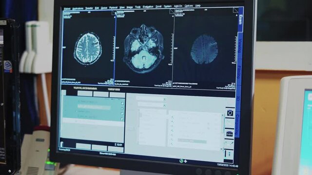 Closeup shot of Computer Screen Showing magnetic resonance image - MRI,  CT Image Scan of the Brain in radiology department
