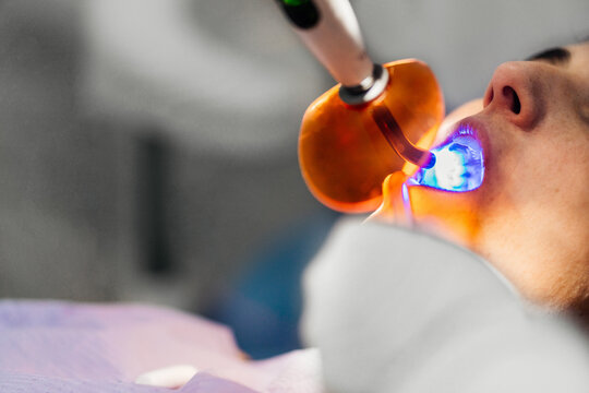 Dentist using ultraviolet curing light to patient
