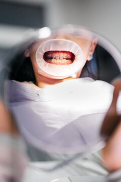 Patient looking at braces on teeth through mirror reflection while visiting dentist in clinic